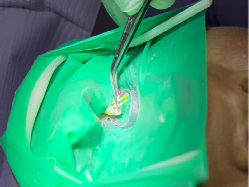 Endodoncia
